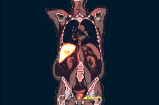 Positron emission tomography (PET) imaging